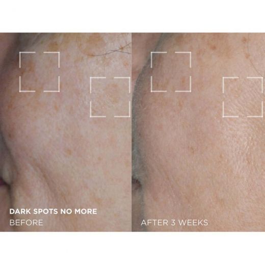Dark Spots No More® Triple Acid Spot Minimizing Concentrate