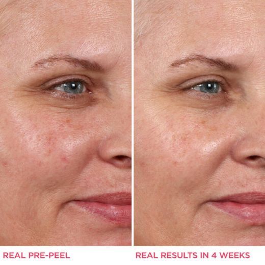 Hello Results Baby-Smooth Glycolic Peel + Caring Oil 