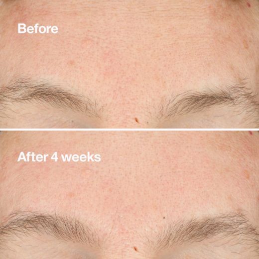 Clarifying Micro-Peel