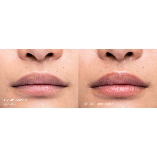 Needles No More® 3-D Lip PlumPfix